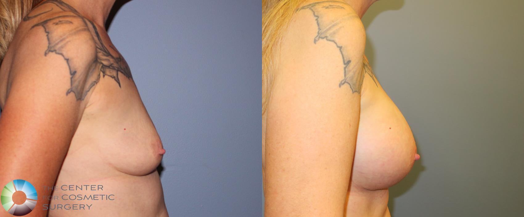 Before & After Breast Augmentation Case 905 View #3 in Denver and Colorado Springs, CO