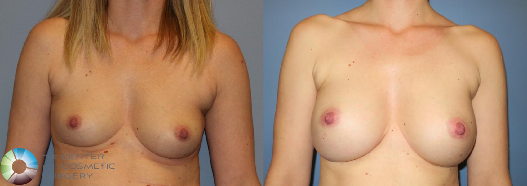 Before & After Breast Augmentation Case 908 View #1 in Denver, CO