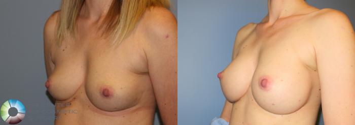 Before & After Breast Augmentation Case 908 View #2 View in Golden, CO