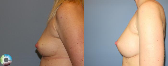Before & After Breast Augmentation Case 908 View #3 View in Golden, CO