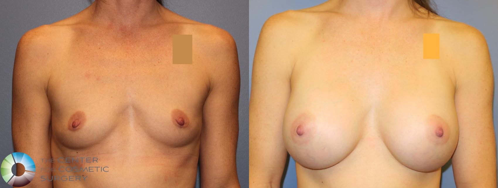 Before & After Breast Augmentation Case 909 View #1 in Denver and Colorado Springs, CO