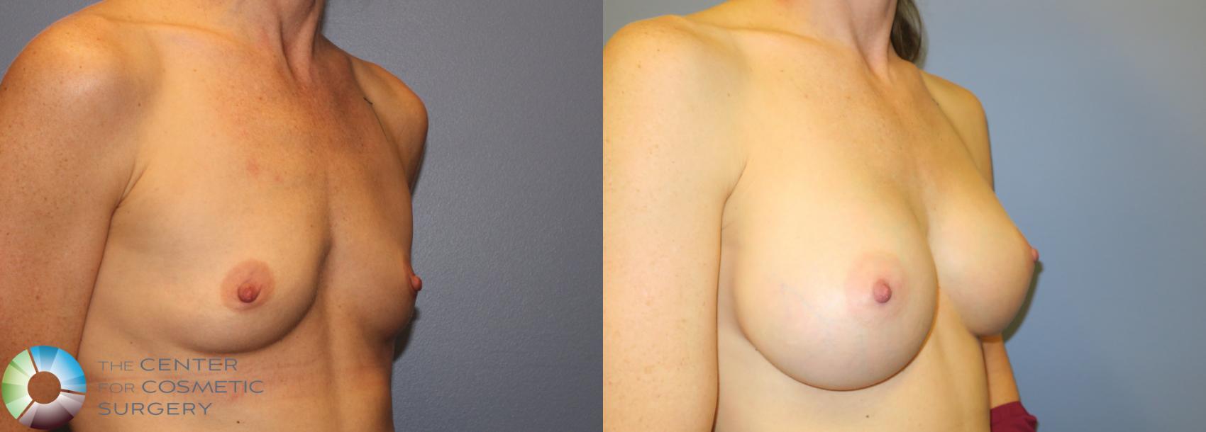 Before & After Breast Augmentation Case 909 View #2 in Denver and Colorado Springs, CO