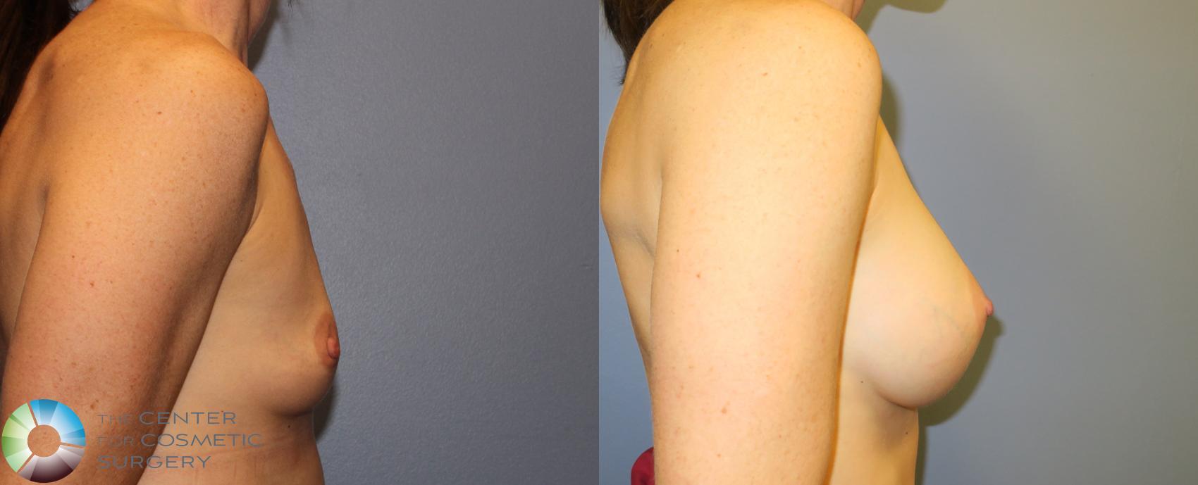 Before & After Breast Augmentation Case 909 View #3 in Denver and Colorado Springs, CO