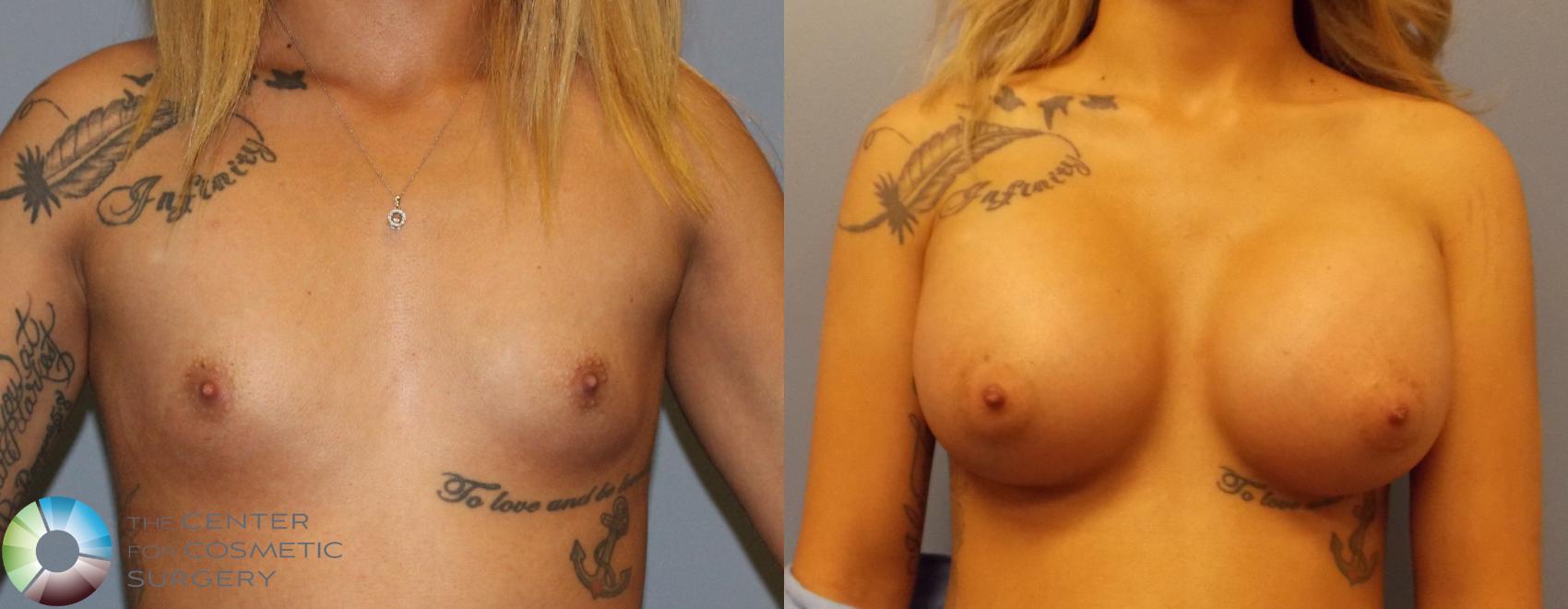 Before & After Breast Augmentation Case 910 View #1 in Denver and Colorado Springs, CO