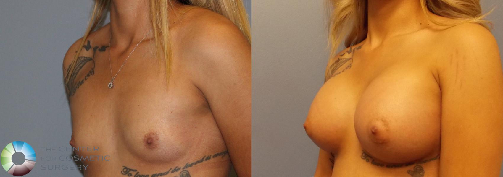 Before & After Breast Augmentation Case 910 View #2 in Denver and Colorado Springs, CO