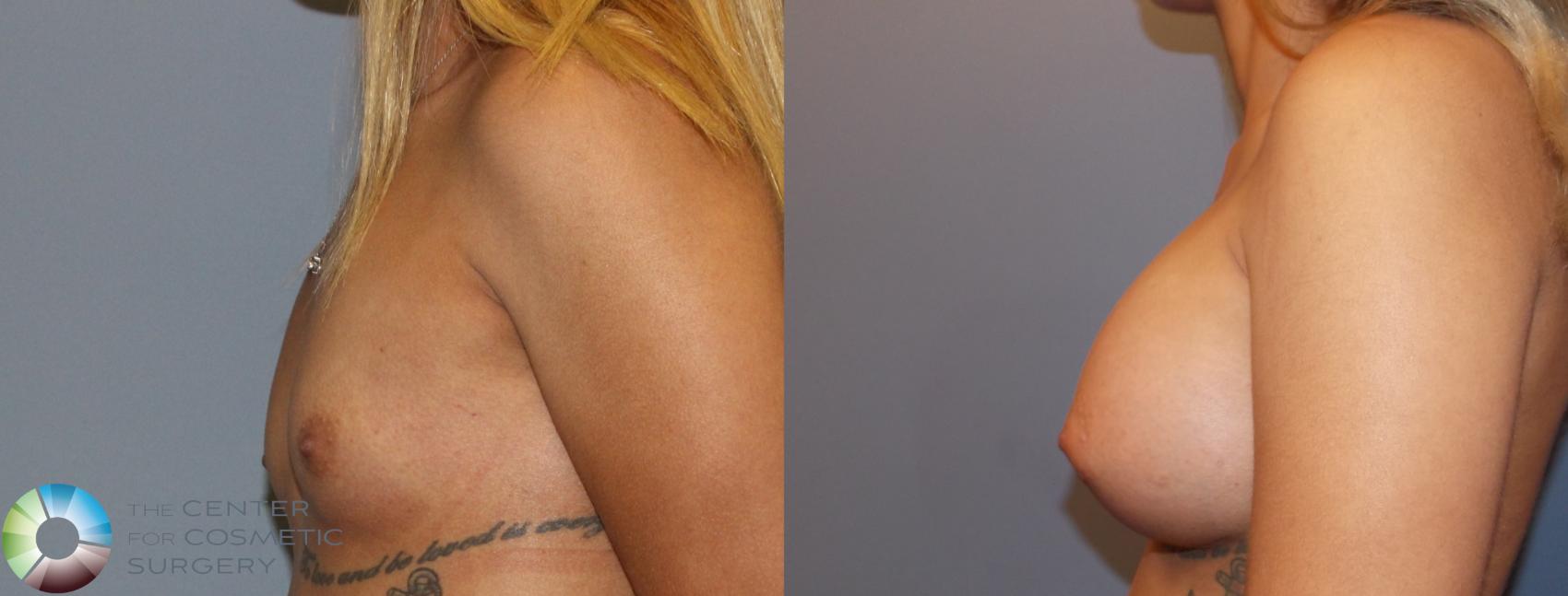 Before & After Breast Augmentation Case 910 View #3 in Denver and Colorado Springs, CO