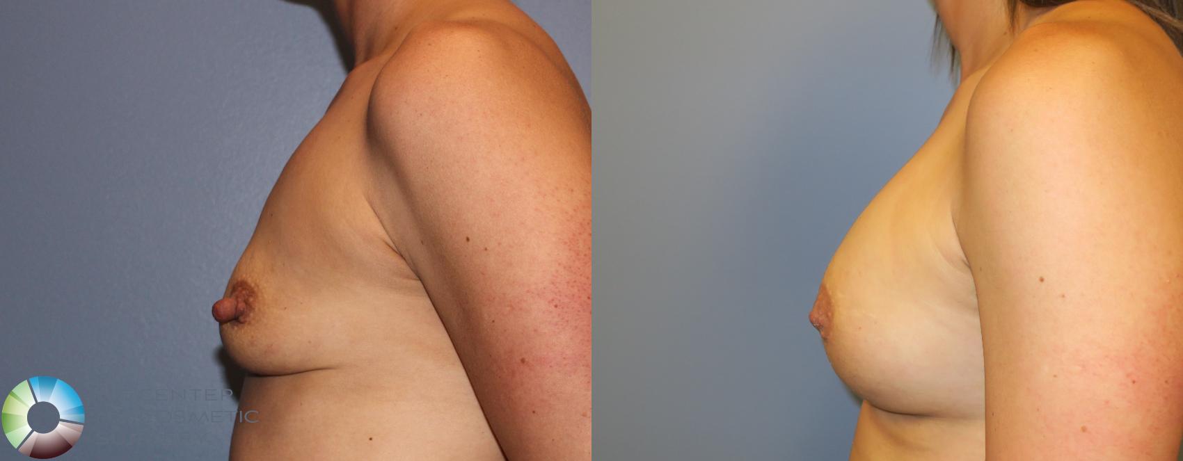 Before & After Nipple reduction Case 911 View #2 View in Denver & Golden, CO