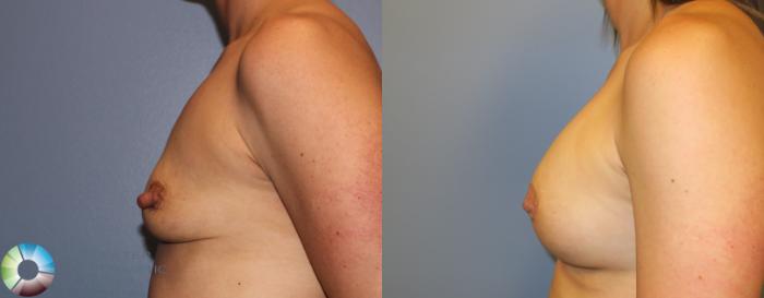 Before & After Breast Augmentation Case 911 View #2 View in Golden, CO