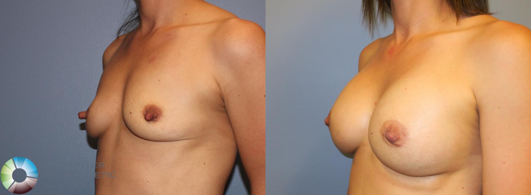 Before & After Breast Augmentation Case 911 View #3 View in Denver & Golden, CO