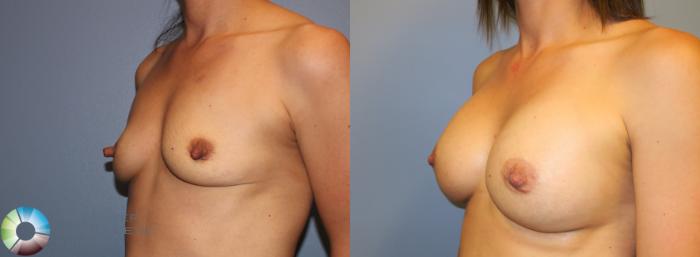 Before & After Breast Augmentation Case 911 View #3 View in Golden, CO