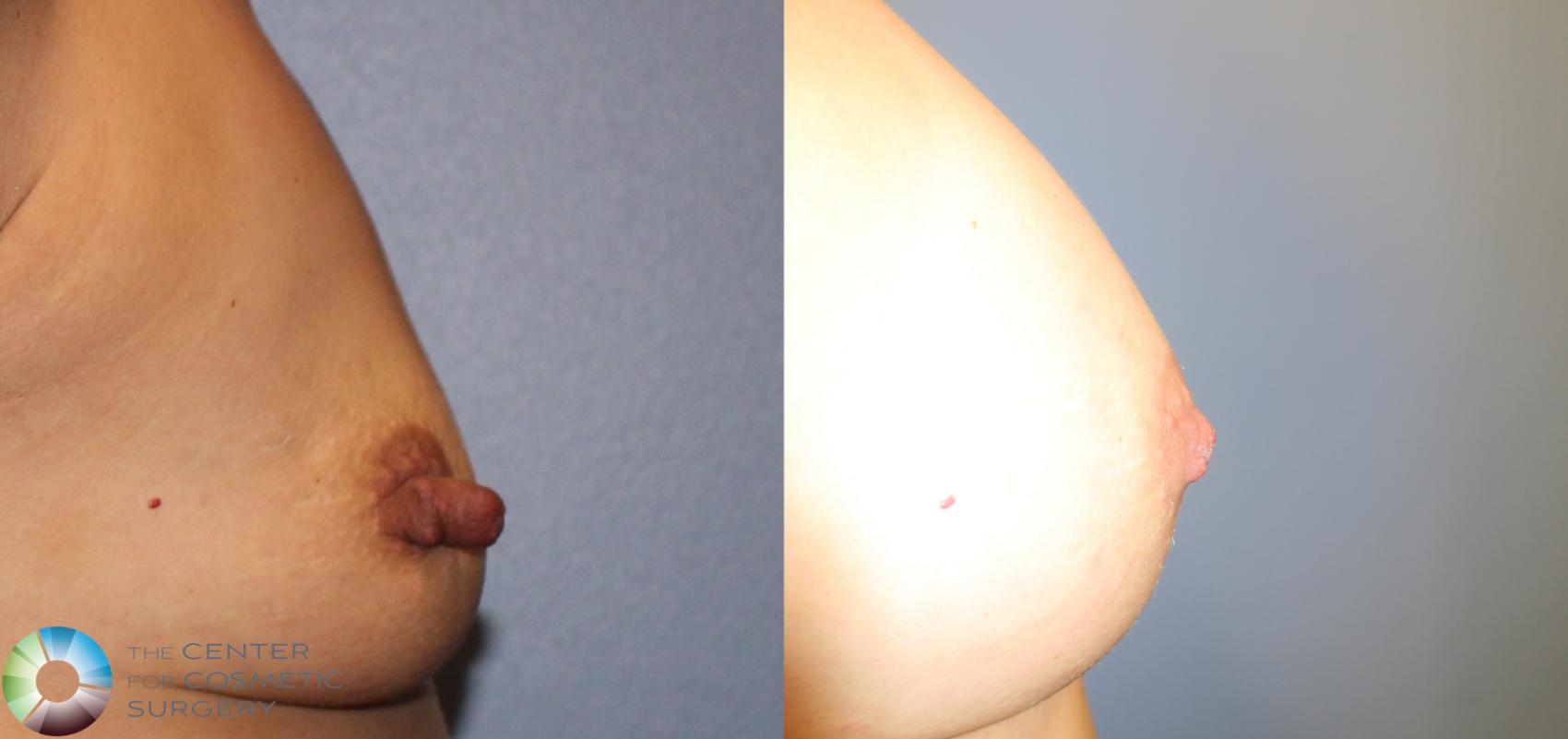 Before & After Breast Augmentation Case 911 View #4 View in Denver & Golden, CO