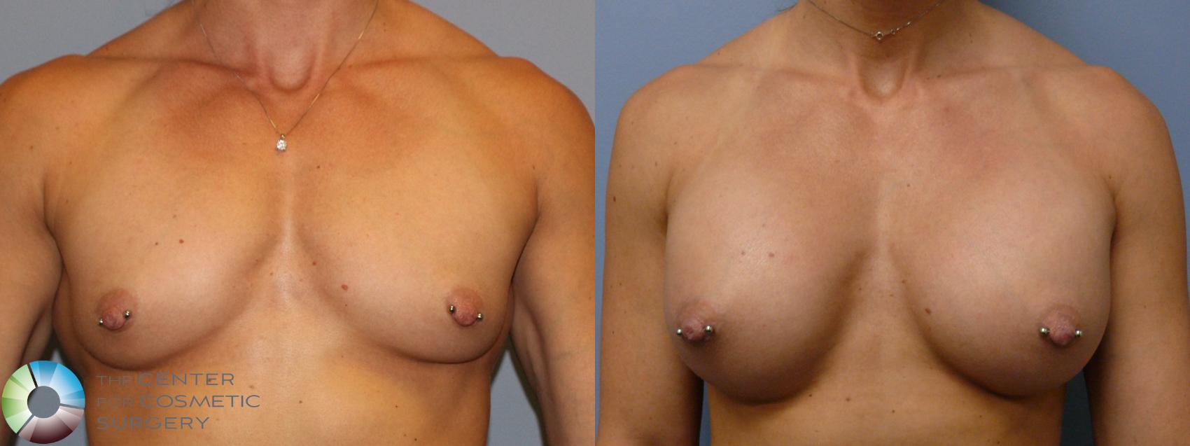 Before & After Breast Augmentation Case 912 View #1 View in Golden, CO