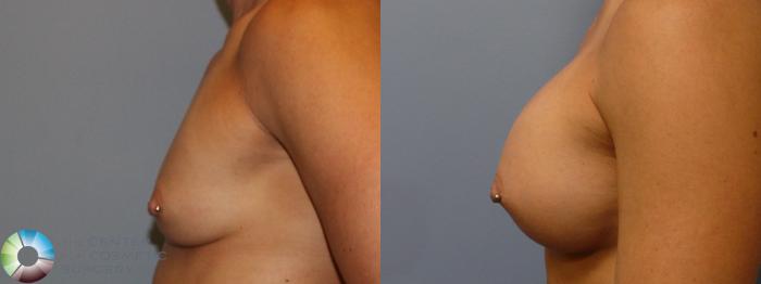 Before & After Breast Augmentation Case 912 View #2 View in Golden, CO