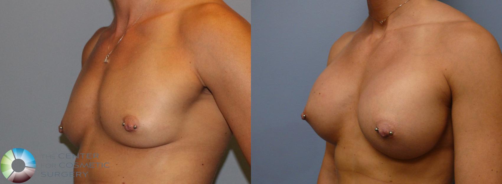 Before & After Breast Augmentation Case 912 View #3 in Denver and Colorado Springs, CO