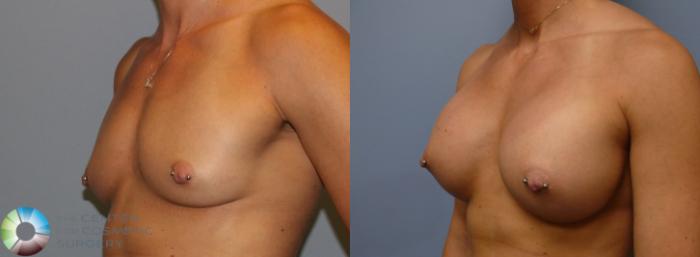 Before & After Breast Augmentation Case 912 View #3 View in Golden, CO
