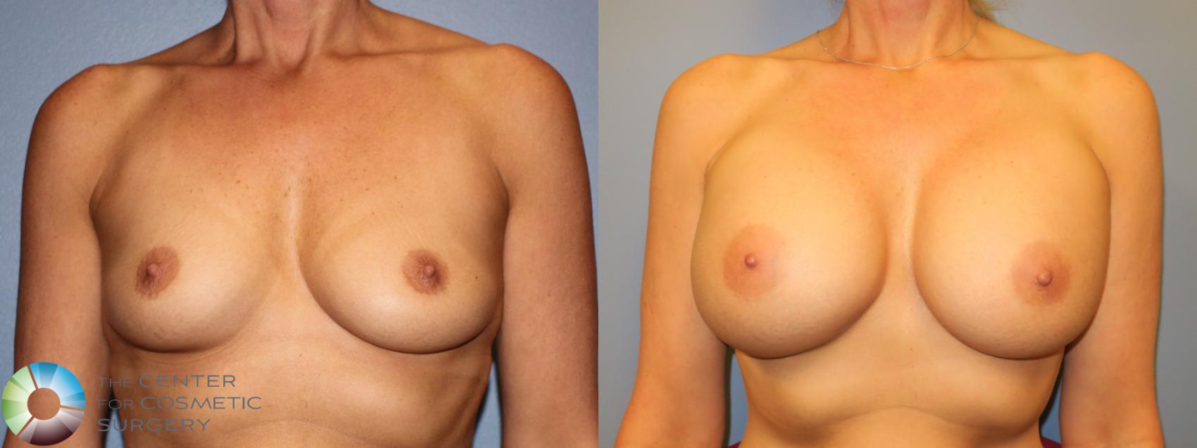 Before & After Breast Augmentation Case 913 View #1 in Denver and Colorado Springs, CO