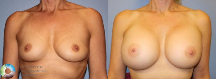 Before & After Breast Augmentation Case 913 View #1 View in Golden, CO
