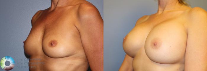 Before & After Breast Augmentation Case 913 View #3 View in Golden, CO