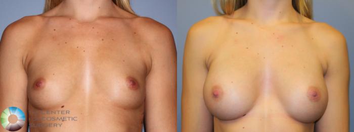Before & After Breast Augmentation Case 914 Anterior View in Golden, CO