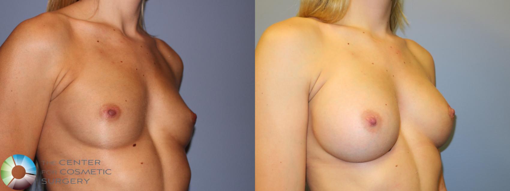 Before & After Breast Augmentation Case 914 Right Oblique View in Golden, CO