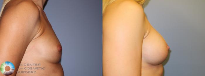 Before & After Breast Augmentation Case 914 Right Side View in Golden, CO