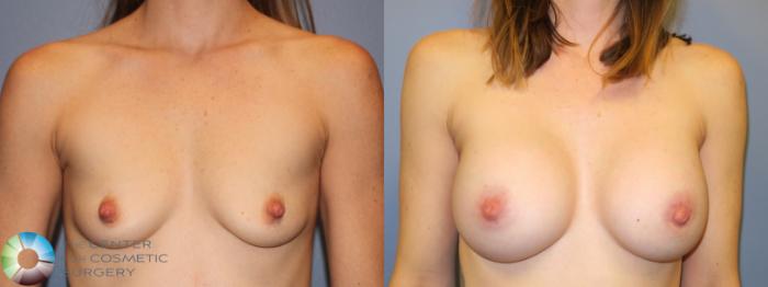 Before & After Breast Augmentation Case 915 Frontal in Denver and Colorado Springs, CO