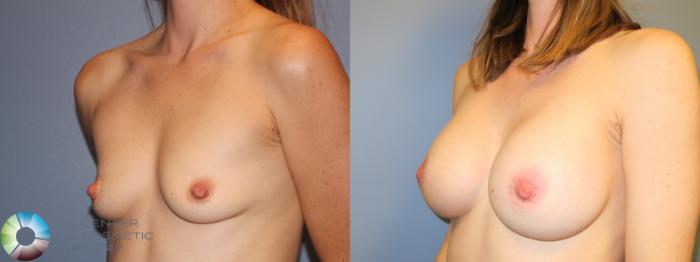 Before & After Breast Augmentation Case 915 Left Oblique in Denver and Colorado Springs, CO