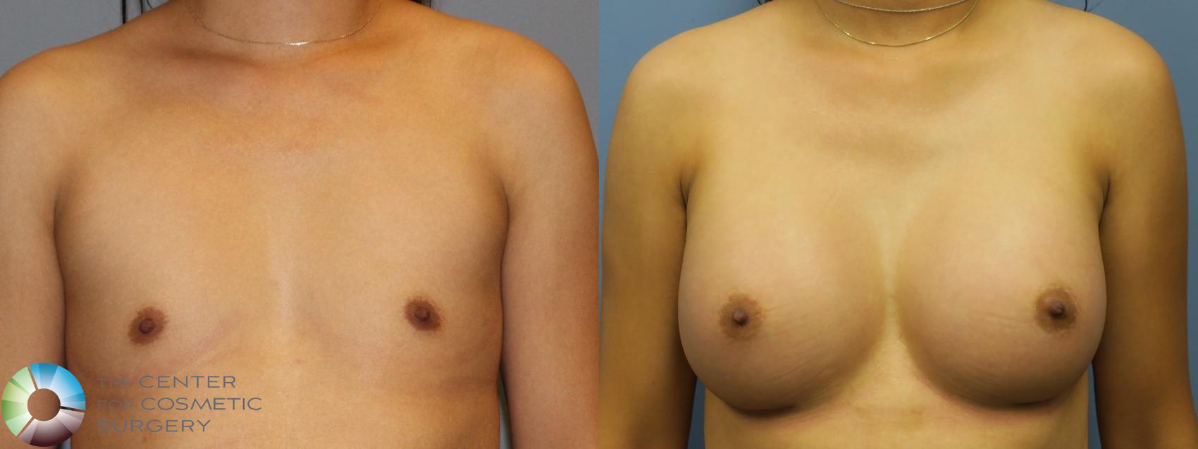 Before & After Breast Augmentation Case 916 View #1 View in Golden, CO
