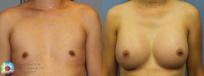 Before & After Breast Augmentation Case 916 View #1 in Denver and Colorado Springs, CO