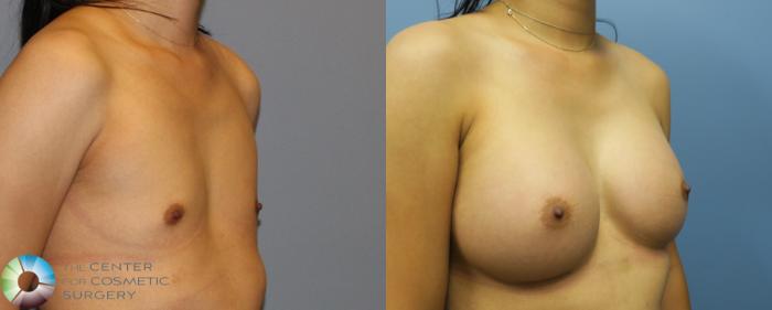 Before & After Breast Augmentation Case 916 View #2 in Denver and Colorado Springs, CO