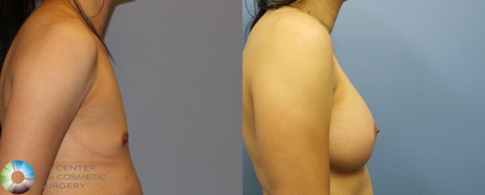 Before & After Breast Augmentation Case 916 View #3 in Denver and Colorado Springs, CO