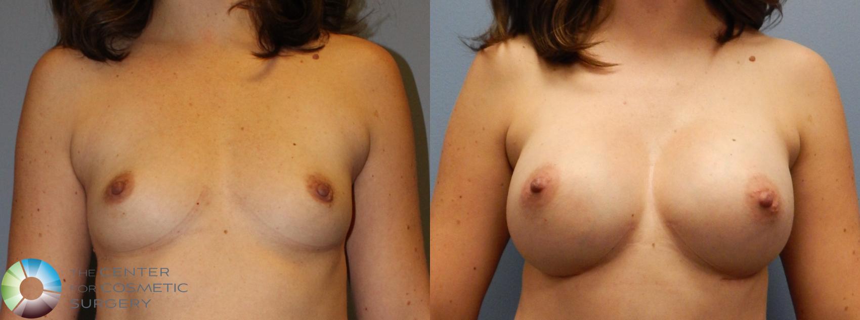 Before & After Breast Augmentation Case 917 View #1 View in Golden, CO