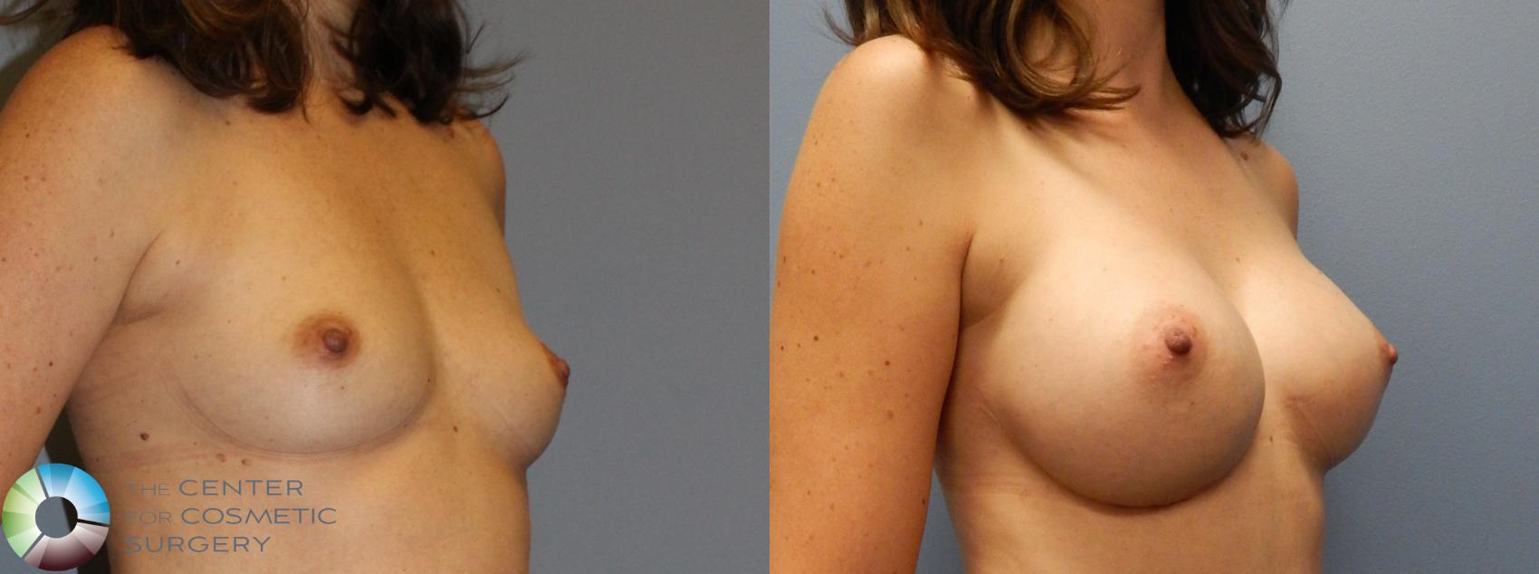 Before & After Breast Augmentation Case 917 View #2 in Denver and Colorado Springs, CO