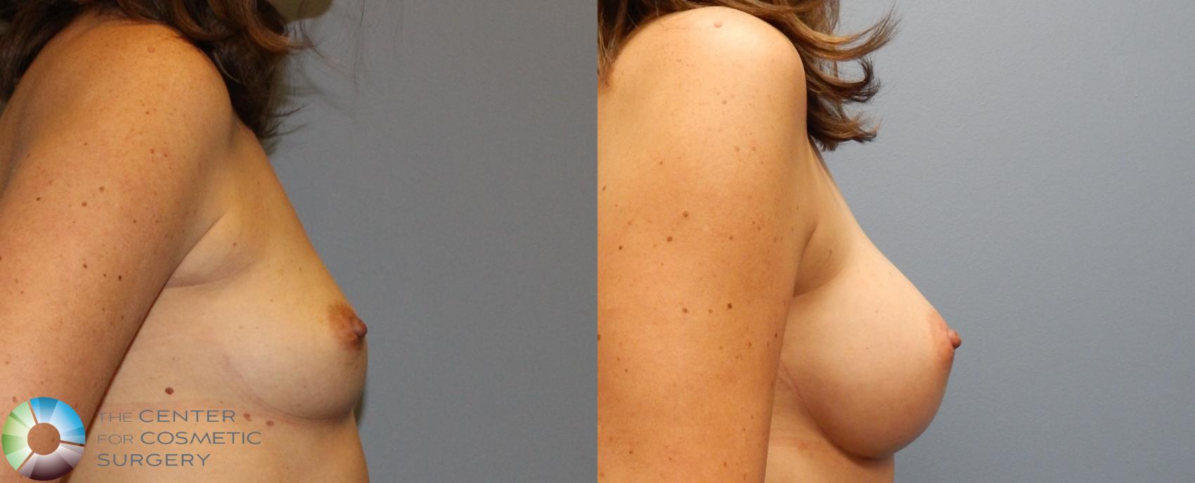 Before & After Breast Augmentation Case 917 View #3 in Denver and Colorado Springs, CO