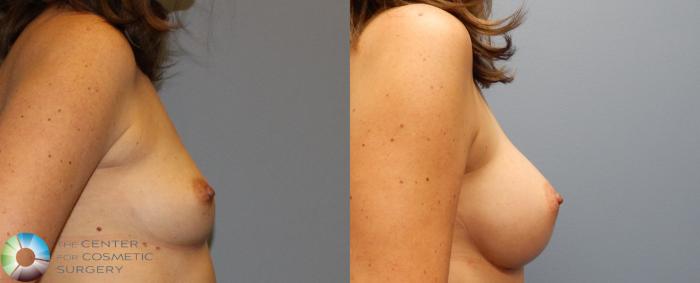 Before & After Breast Augmentation Case 917 View #3 View in Golden, CO
