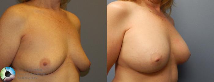 Before & After Breast Augmentation Case 918 View #1 View in Golden, CO