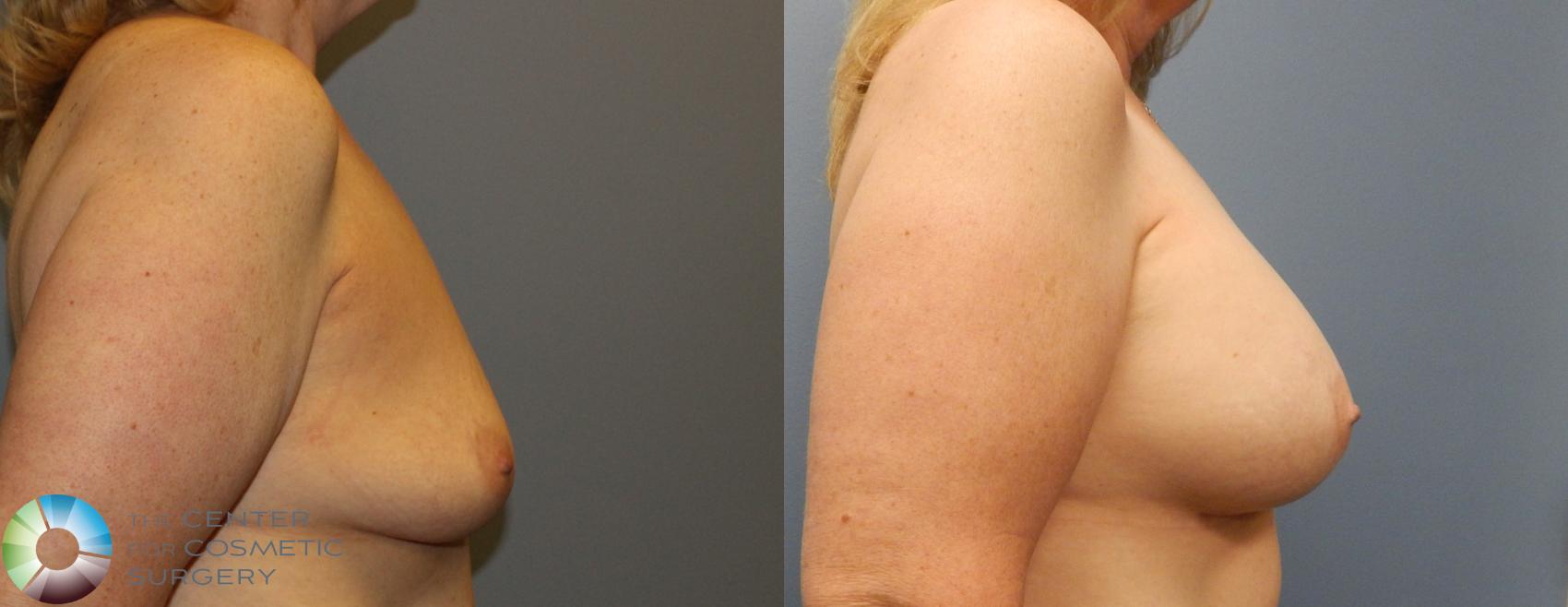 Before & After Breast Augmentation Case 918 View #2 in Denver and Colorado Springs, CO