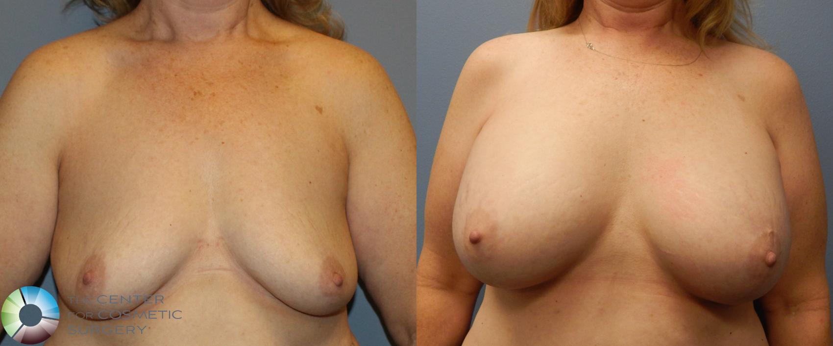 Before & After Breast Augmentation Case 918 View #3 in Denver and Colorado Springs, CO
