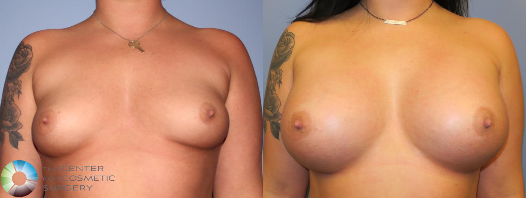 Before & After Breast Augmentation Case 919 View #1 View in Golden, CO