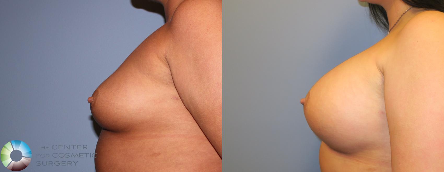 Before & After Breast Augmentation Case 919 View #2 in Denver and Colorado Springs, CO