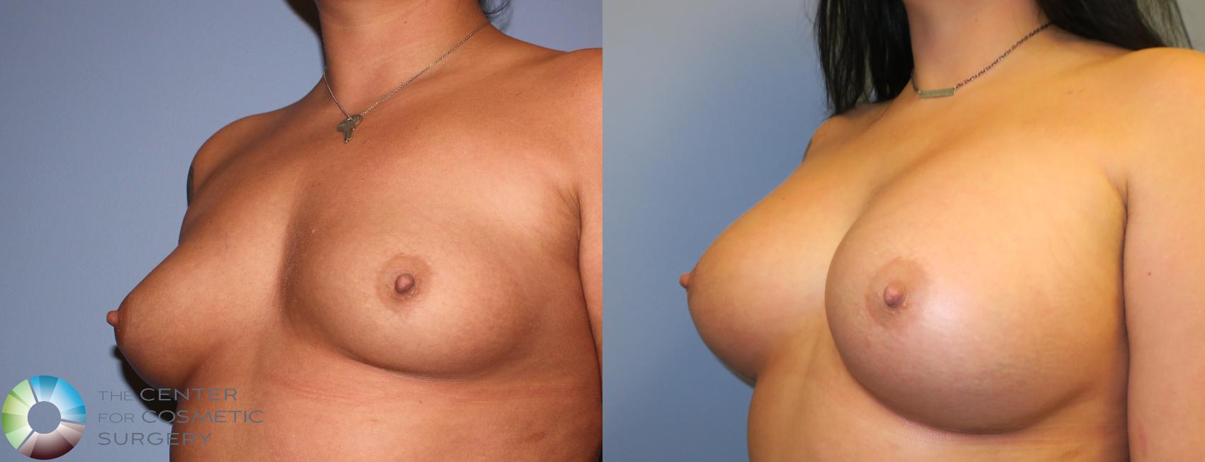 Before & After Breast Augmentation Case 919 View #3 in Denver and Colorado Springs, CO