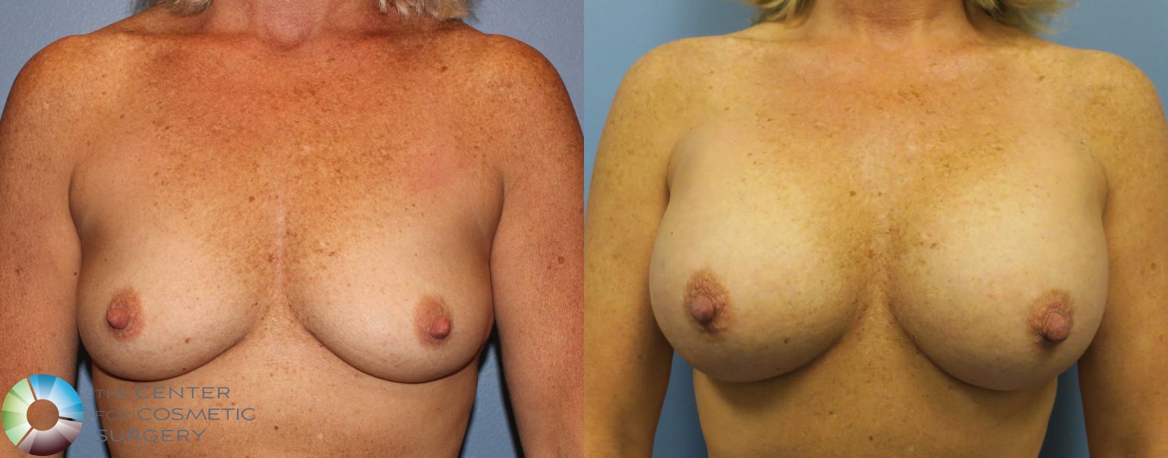 Before & After Breast Augmentation Case 920 View #1 View in Golden, CO