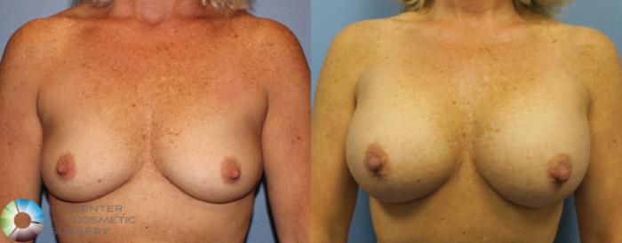 Before & After Breast Augmentation Case 920 View #1 in Denver and Colorado Springs, CO