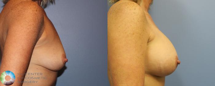 Before & After Breast Augmentation Case 920 View #2 in Denver and Colorado Springs, CO