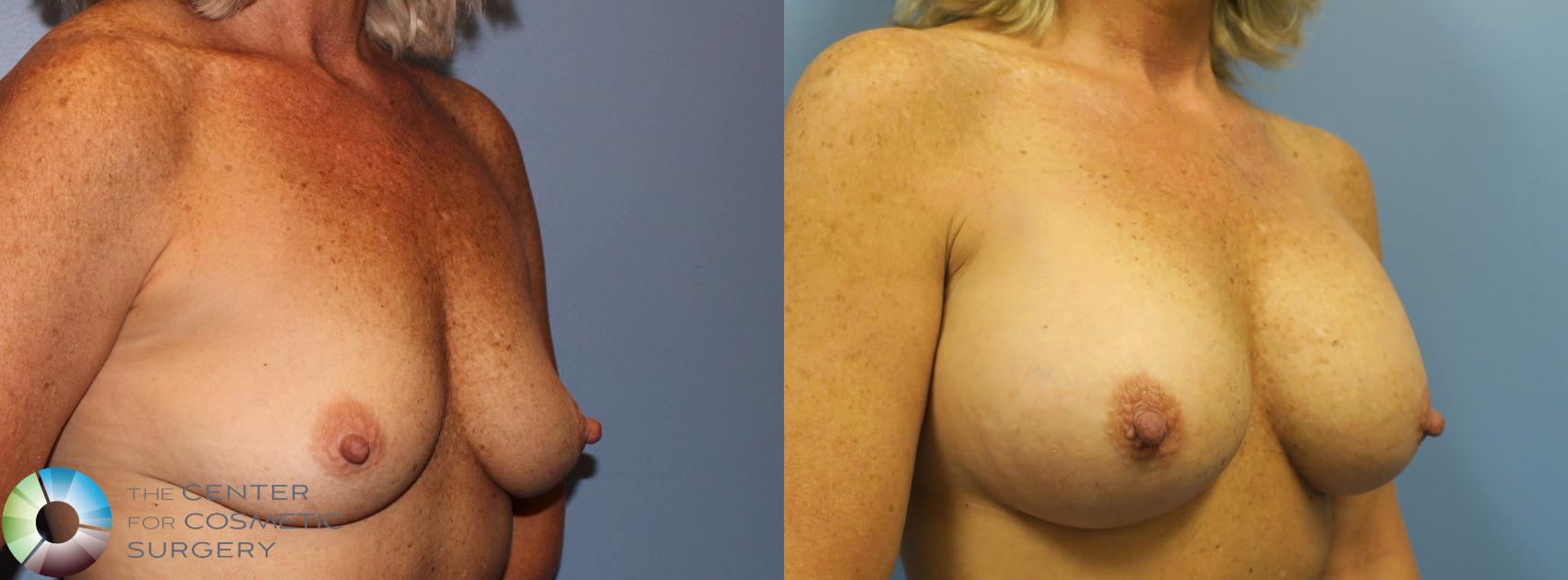 Before & After Breast Augmentation Case 920 View #3 View in Golden, CO