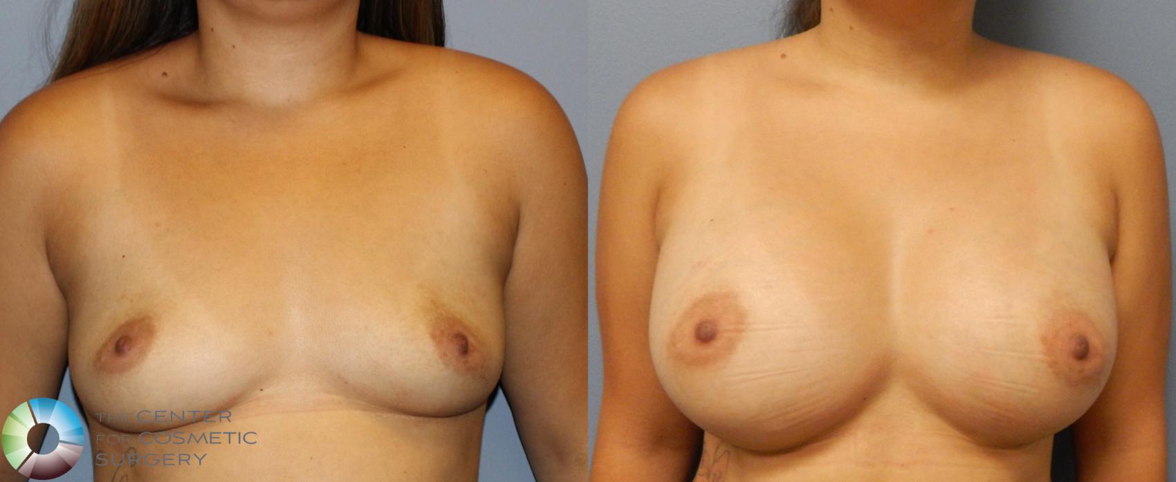 Before & After Breast Augmentation Case 921 View #1 in Denver and Colorado Springs, CO