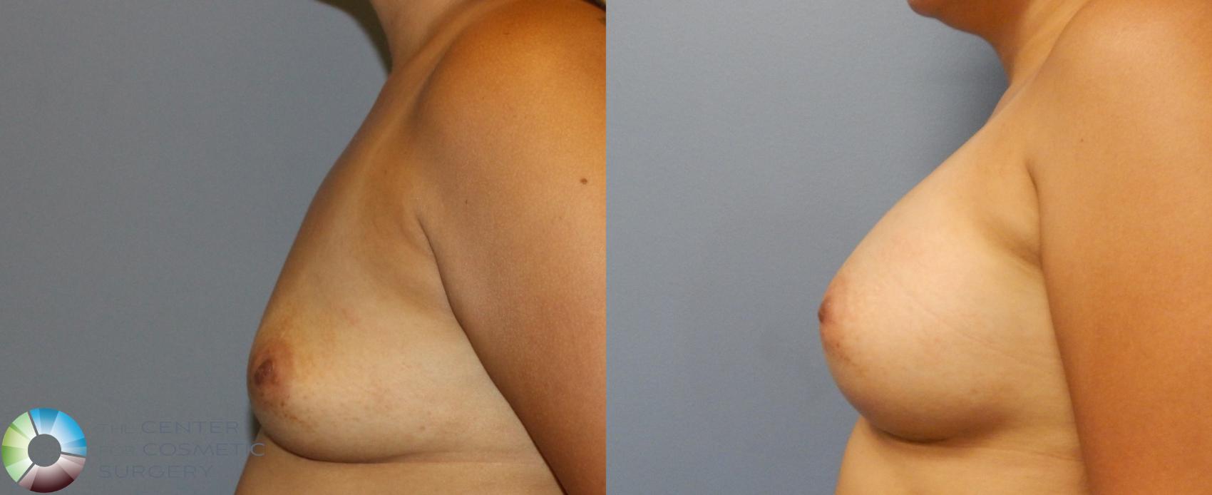 Before & After Breast Augmentation Case 921 View #2 in Denver and Colorado Springs, CO