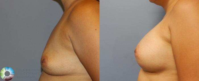 Before & After Breast Augmentation Case 921 View #2 View in Golden, CO