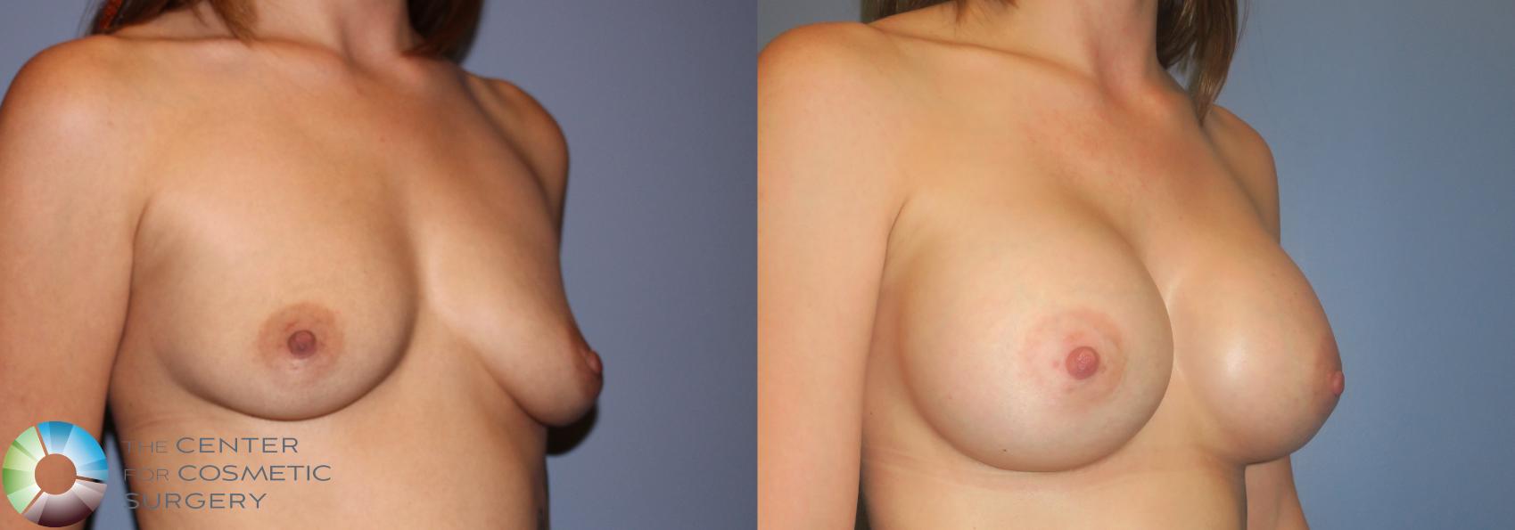 Before & After Breast Augmentation Case 924 View #2 View in Golden, CO
