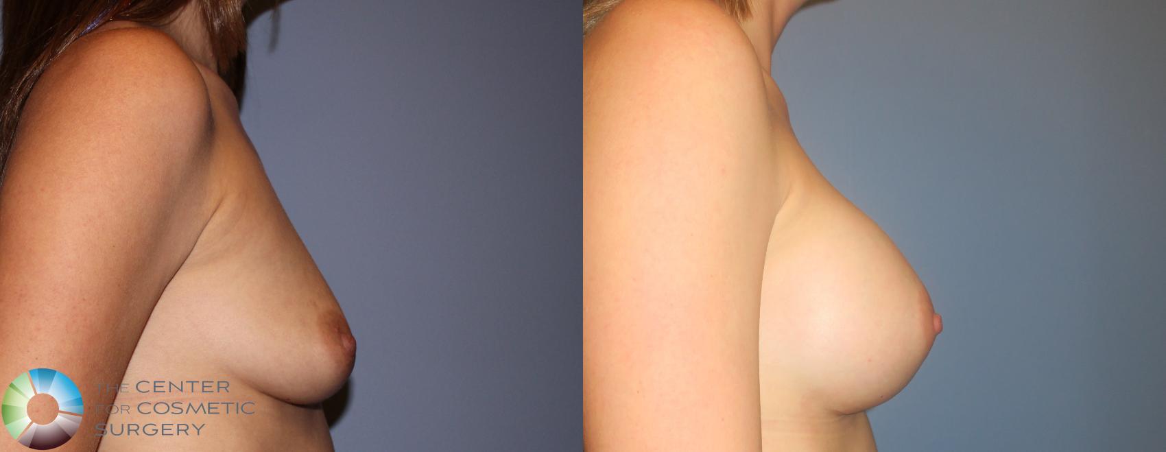 Before & After Breast Augmentation Case 924 View #3 View in Golden, CO